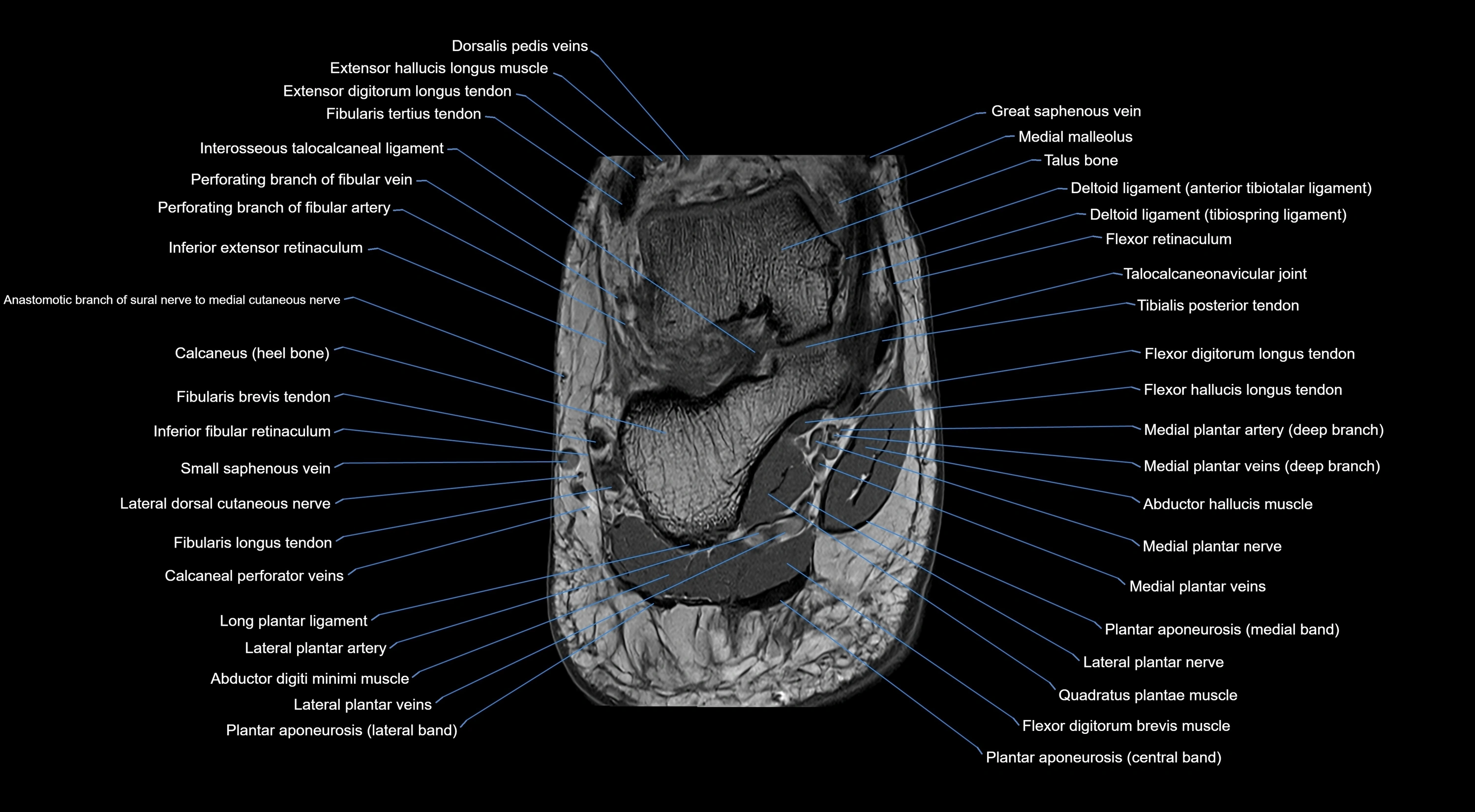 MRI mid foot coronal ligaments cross sectional anatomy 3T  radiology  image-img-00001-00045.webp